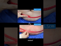 फ्रीज वसा, 1 घंटे में 4 सेमी खोना!