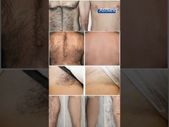 लेजर बाल हटाने से पहले और बाद में