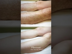 नवीनतम फाइबर लेजर हेयर रिमूवल मशीन, एस्टिलैंड फाइबरमैक्स का परिचय!